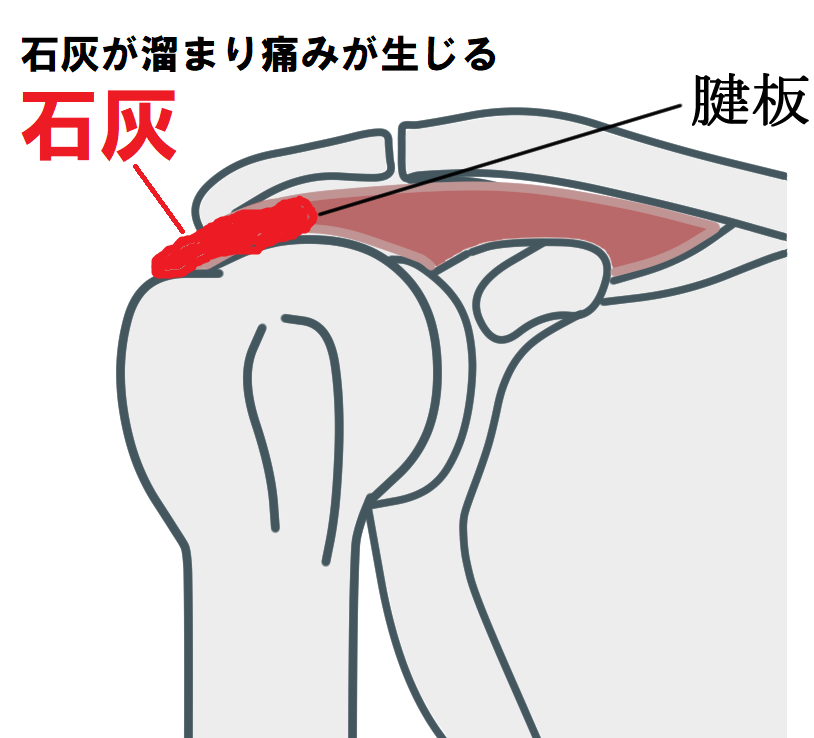 石灰沈着性腱板炎